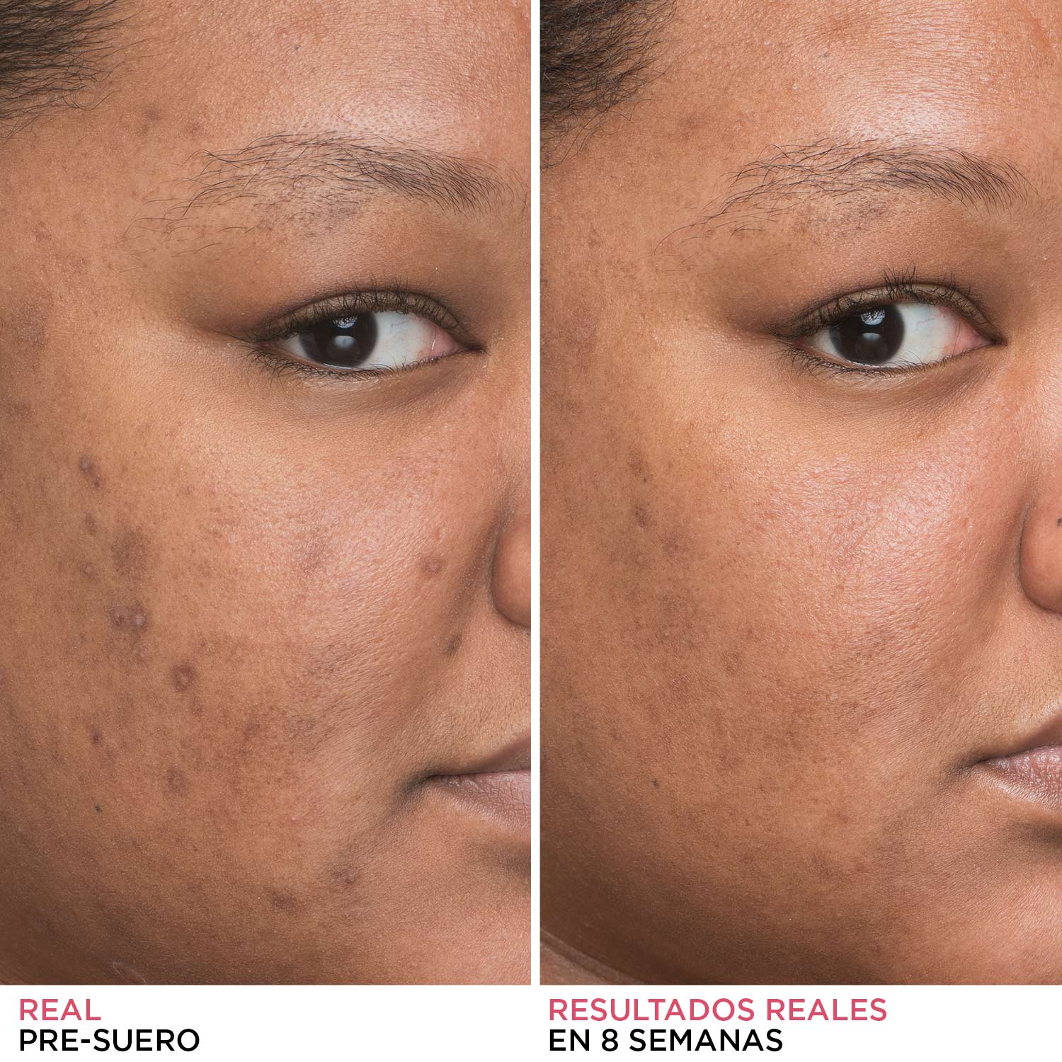 BYE BYE DARK SPOTS (SUERO DE NIACINAMIDA )